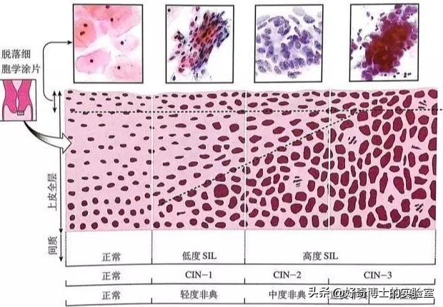 做妇科的活检是什么,妇科做活检是什么
