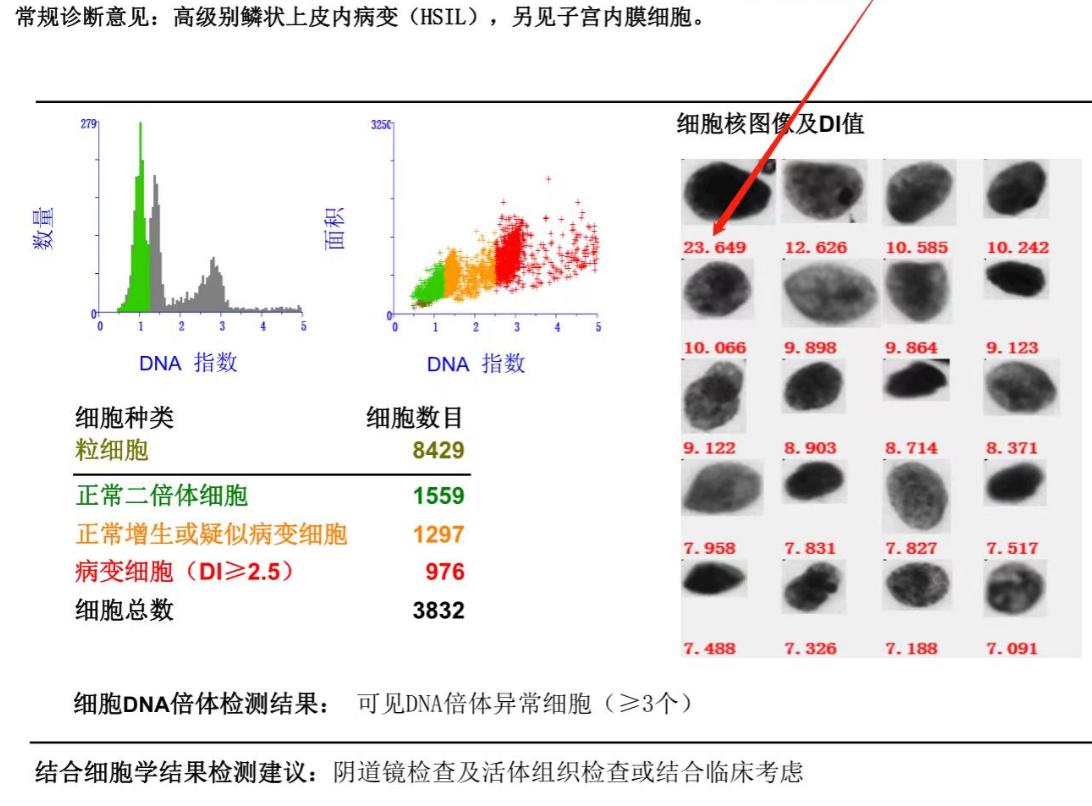 HPV感染和宫颈癌的预防与早期发现