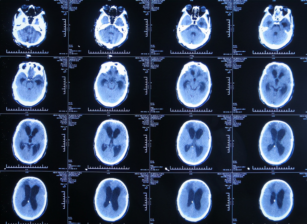 脑外伤后硬膜下积液颅骨修补,颅骨修复手术失败导致脑积水