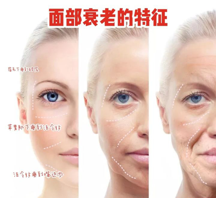 拉皮成功整容案例,拉皮提升面部手术对比图