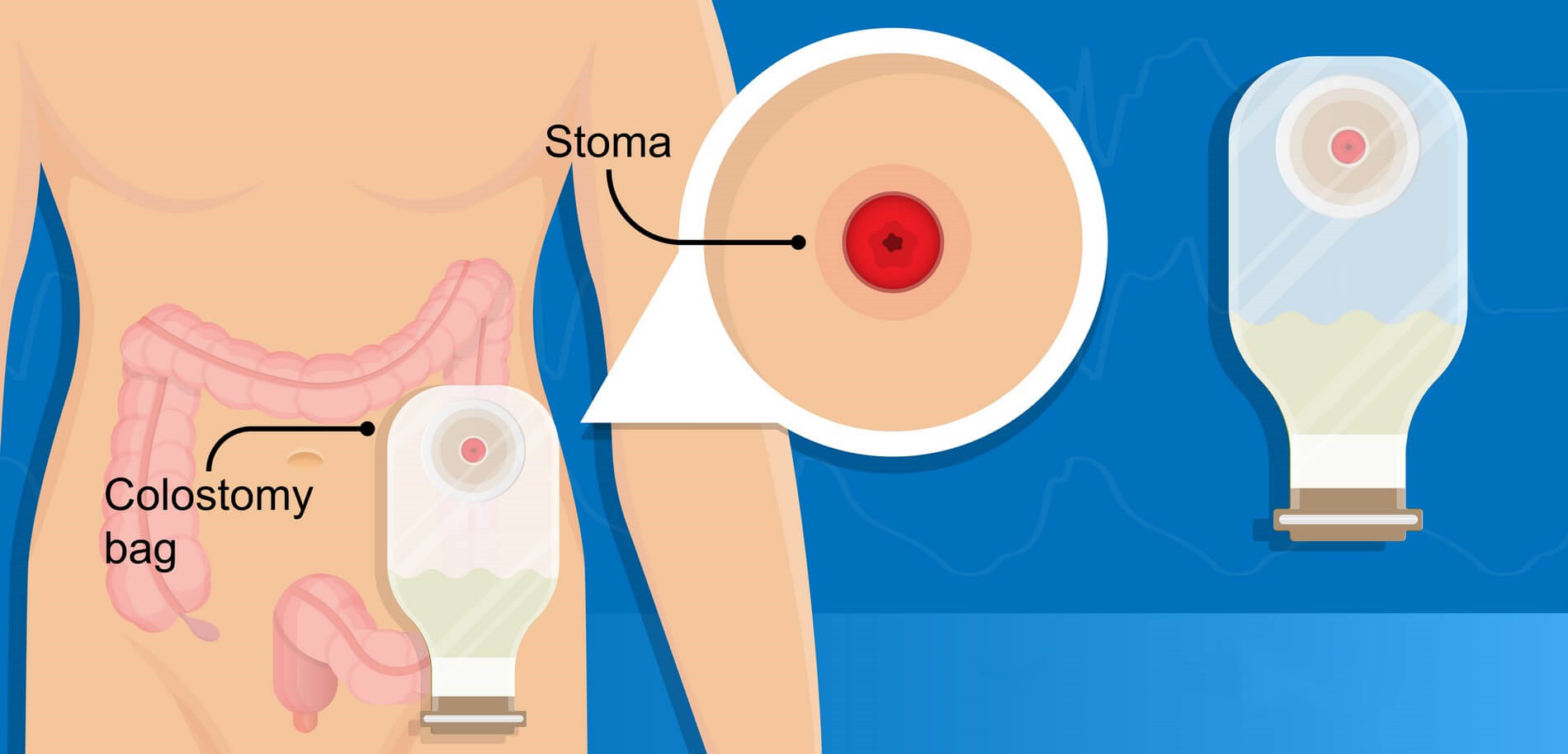 没有大便肛门却流血要怎么治疗,正常人怎么排便