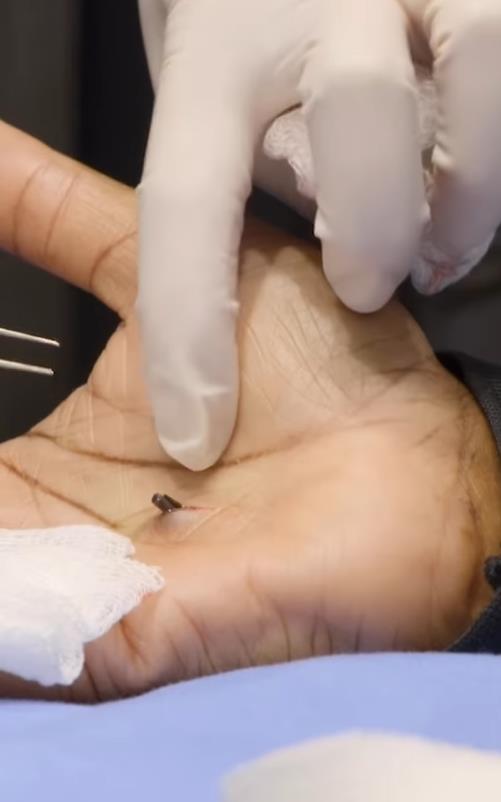 美国女子被橡皮子弹击中,女子手术取出戳20年铅笔芯