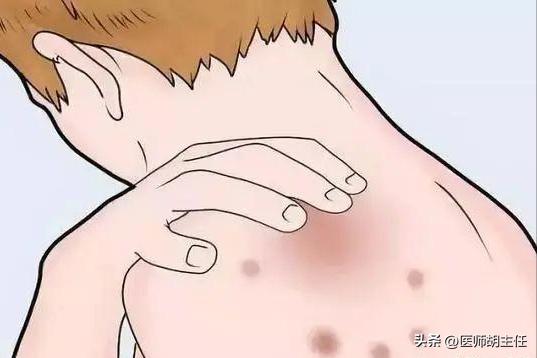 湿疹和荨麻疹汗疱疹同时出现吗,汗疱疹后期干裂瘙痒用什么药