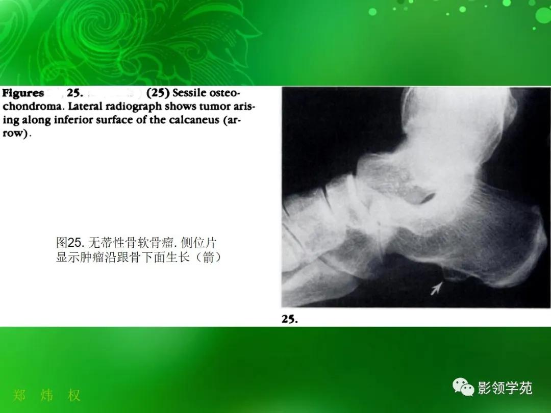 正常跟骨影像图,跟骨正常与变异影像表现图片