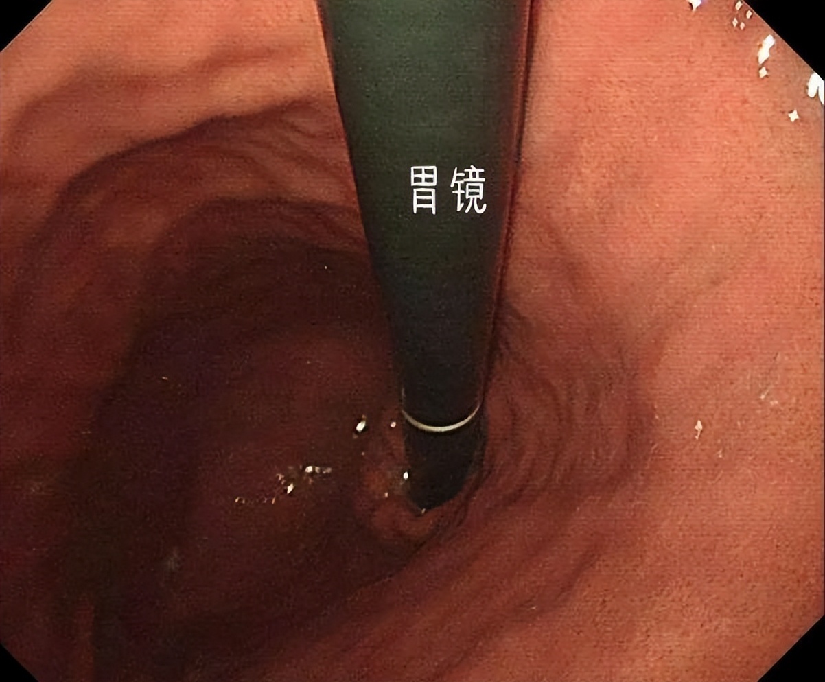 做完胃镜怎么看报告,做完胃镜怎么看胃有没有问题