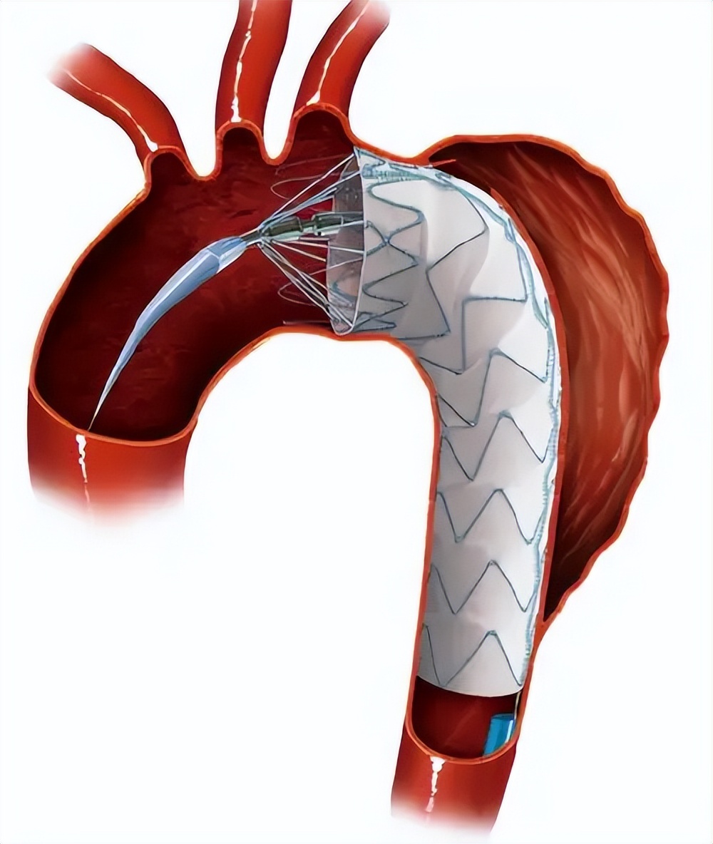 70岁动脉夹层第一层破裂能活多久,老人80了心脏动脉夹层破裂有救吗