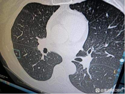 “这是一场爱的接力”，5mm多发磨玻璃结节微浸润腺癌患者感叹