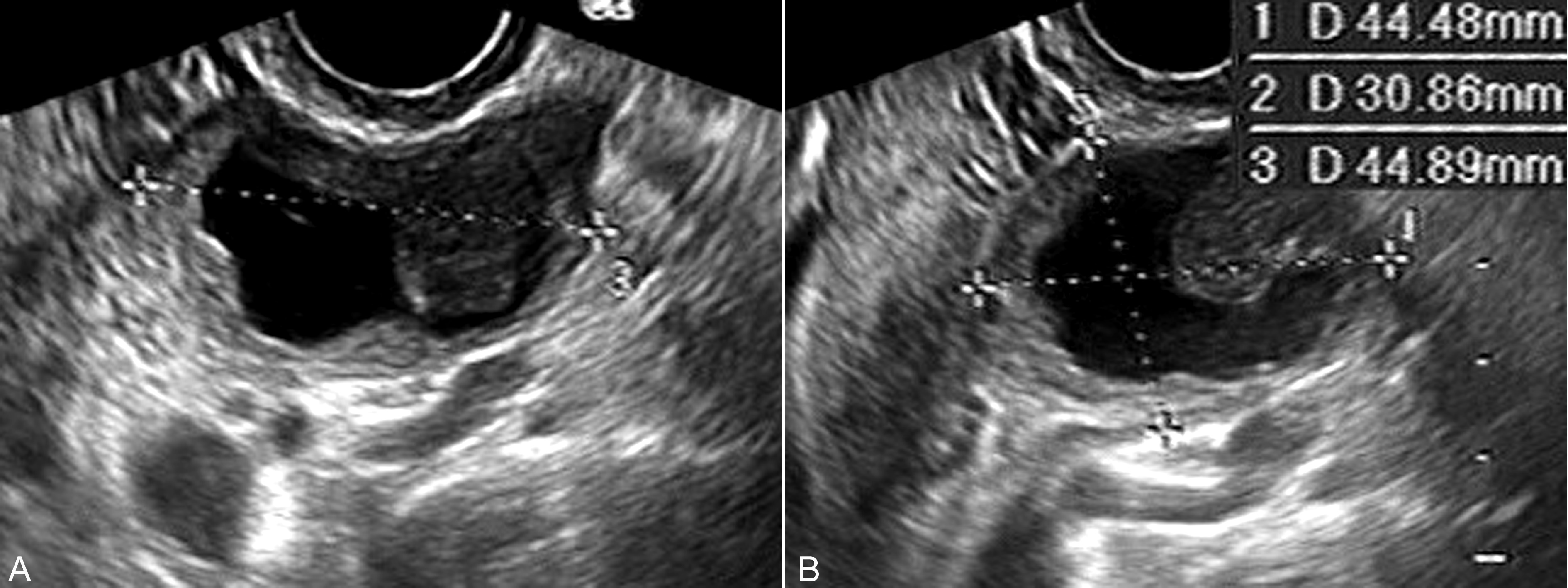 怀孕检查卵巢肿瘤良性恶性几率,妊娠合并卵巢肿瘤的鉴别诊断