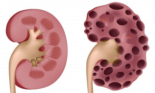 肾囊肿多大对身体造成严重影响,关于肾囊肿大小及处理方法