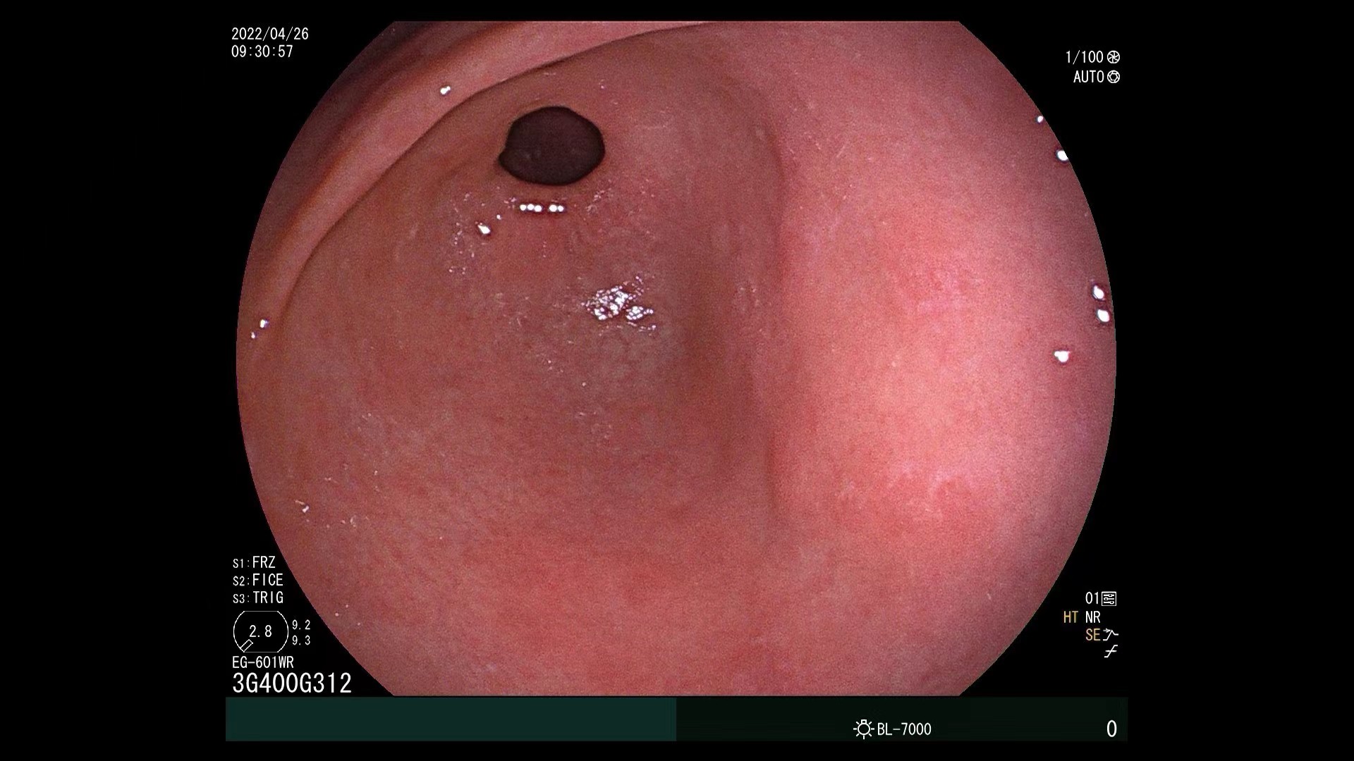 胃片怎么拍,胃造影的流程