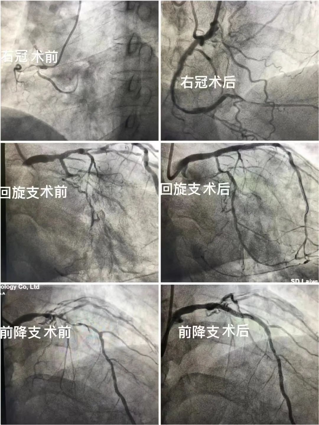 济南二院血管造影专家,济南哪个医院能做血管造影
