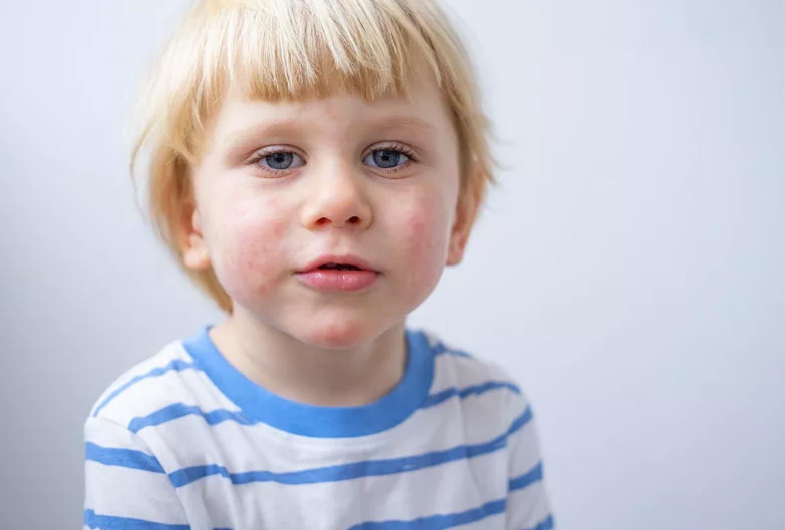 湿疹反复发作如何除根应做何检查,2个月宝宝湿疹反复发作如何除根