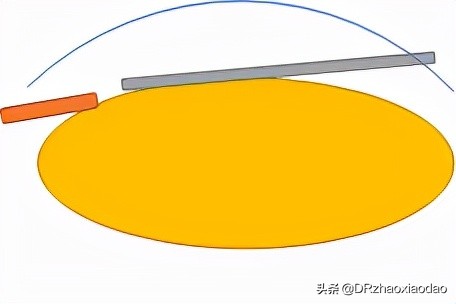 icl植入术技术问题,icd植入适应症指南