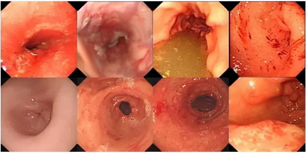 大便带血对身体有什么危害,大便带血什么问题