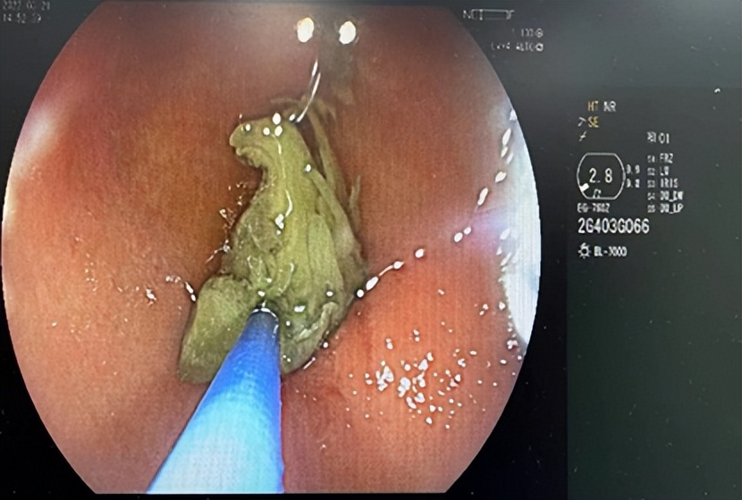 七旬大伯一吃就吐，发现胃里堵着一团酸菜！医生：“罪魁祸首”不是它