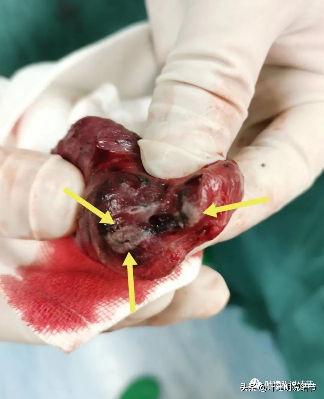 右下叶磨玻璃结节5*4,右下叶磨玻璃样结节多为炎性