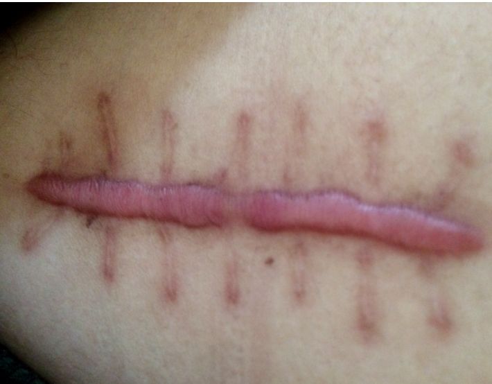 额头眉心发红有闭口粉刺,眉心鼻头频繁起粉刺怎么办