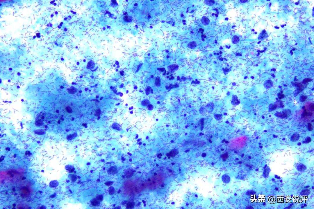 西安大兴医院：专找太爱干净的人！这种妇科病极易被误诊