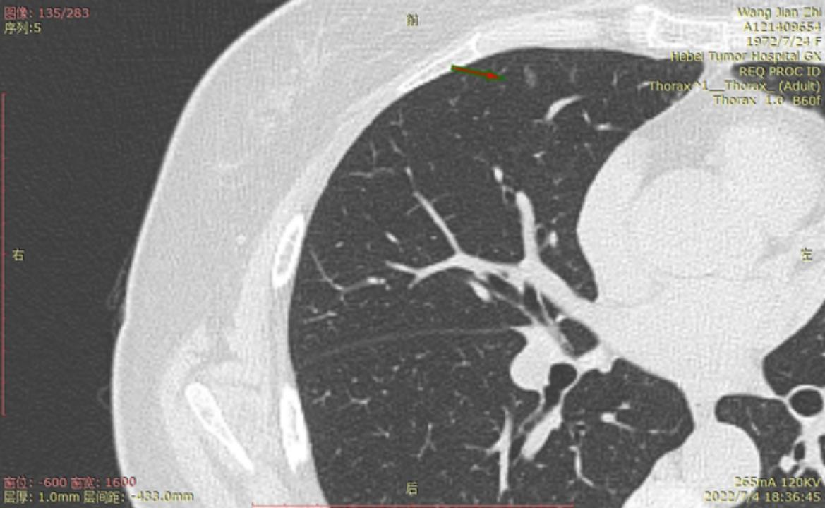 首次发现磨玻璃结节要吃药消炎吗,磨玻璃结节警惕合并占位