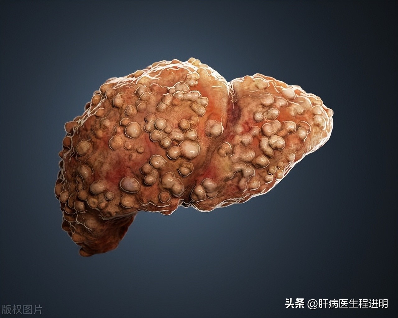 肝脏0.6厘米稍强回声结节怎么治疗,乙肝患者肝脏有结节是怎么回事