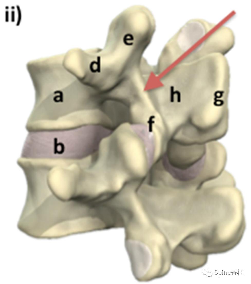 轻度峡部裂和重度峡部裂的区别,真性峡部裂和假性峡部裂