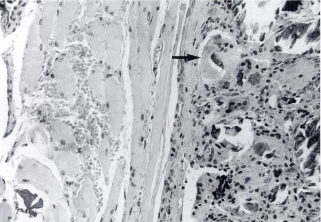 颈长肌腱炎影像表现,三头肌钙化性肌腱炎治疗