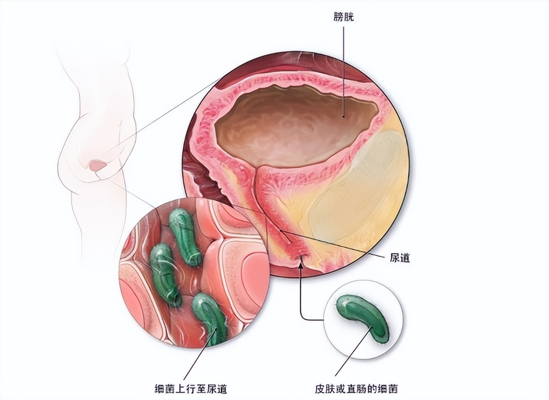 尿路感染自救方法,尿路感染怎样长期抑菌治疗