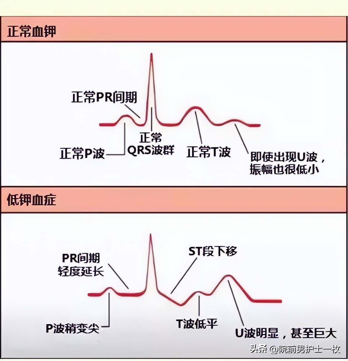 低钾性周期性麻痹怎么补钾,低钾老人吃哪些食物可以补钾啊