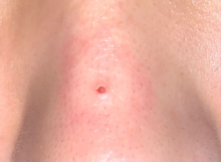 黑头没有弄出来就封口了怎么办,贴黑头贴导致毛孔变大怎么办