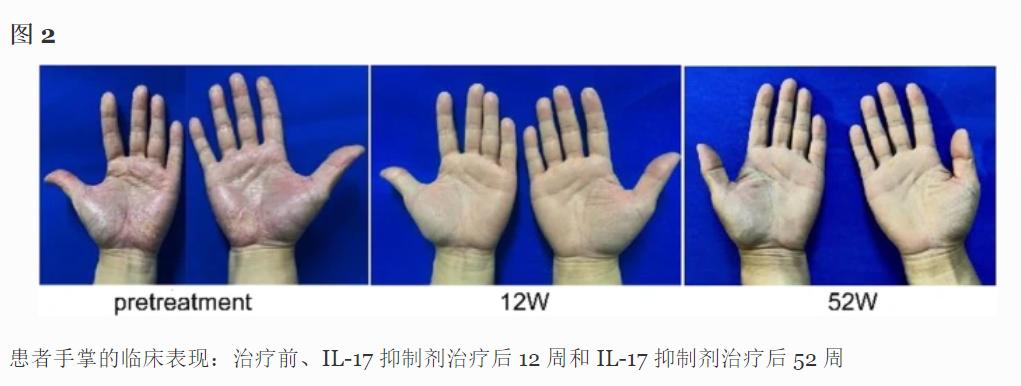 COVID-19疫苗接种后SAPHO综合征并发甲状腺功能异常的病例