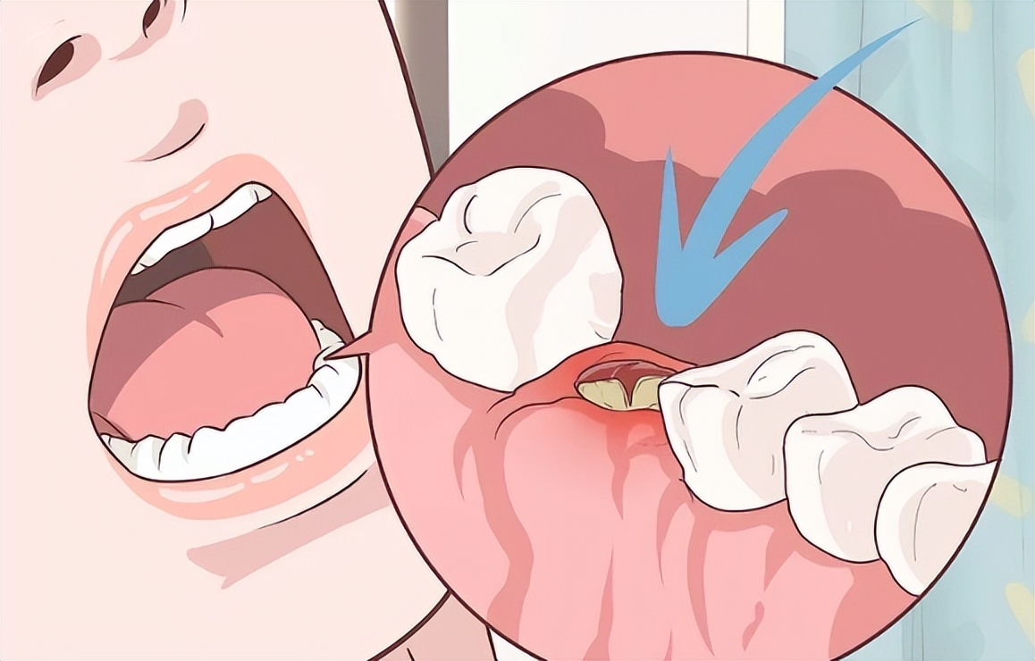 拔牙后有助于伤口愈合的药,拔牙后怎样让伤口快速愈合