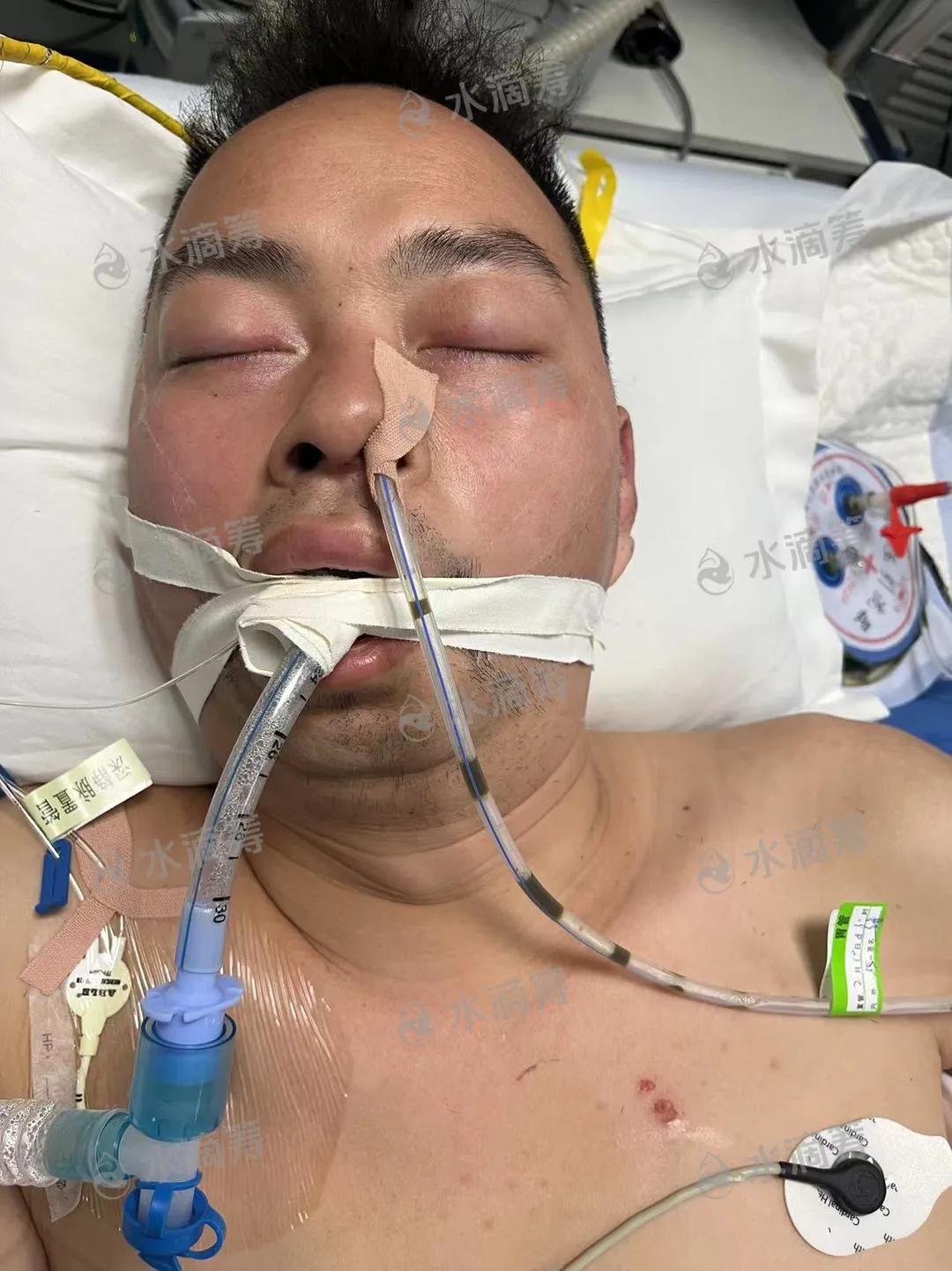 老公急性重症胰腺炎,丈夫病重急需救命