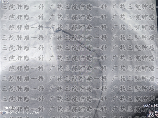 骨髓瘤误诊的可能性有多大,骨髓瘤能治愈吧