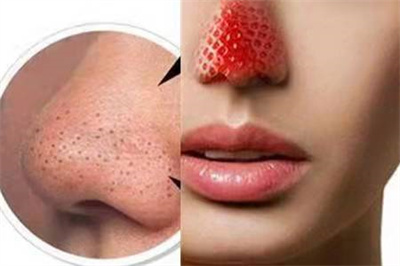 去鼻子黑头粉刺的过程,镊子去除鼻子上的黑头