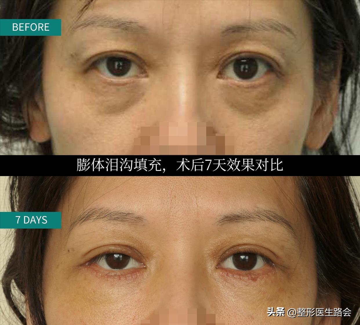 40岁泪沟用什么填充最好,40岁眼袋泪沟最好的解决方法