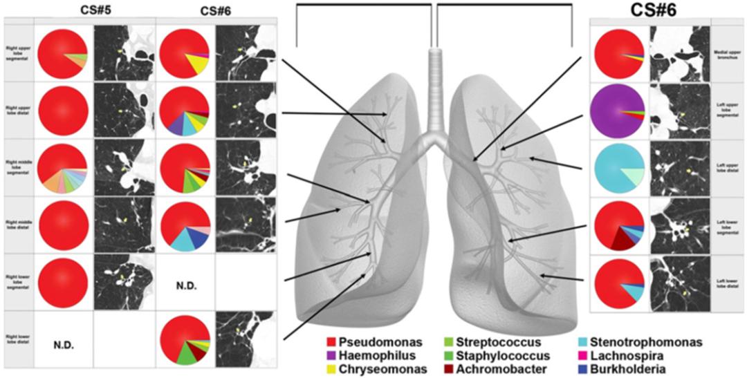 周敏教授：慢阻肺病、支扩及慢阻肺支扩重叠综合征气道微生物研究