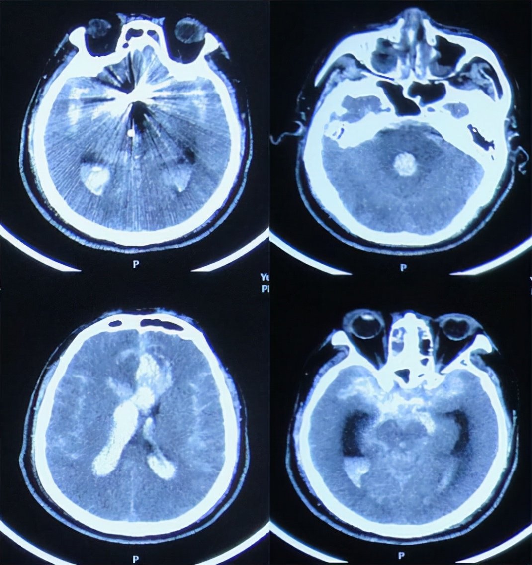 前交通动脉瘤破裂后开颅治疗风险,脑前交通动脉瘤破裂出血