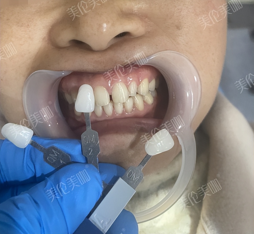 牙缝大做过贴面拆下来还能戴牙套,牙缝大做了两颗全瓷牙现在好后悔