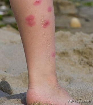 被蚊虫叮咬起大包涂仙人掌有用吗,儿童大腿内侧蚊虫叮咬大包红肿硬