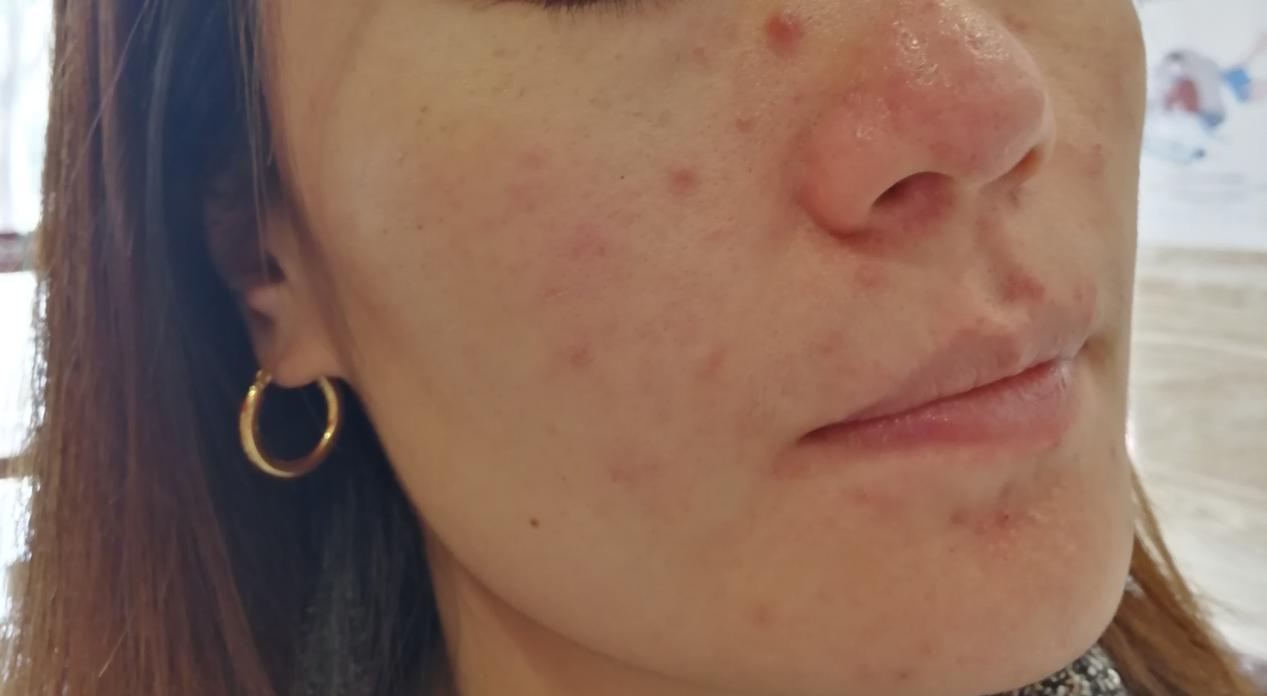 女人脸上反复长痘是什么原因,女人最容易长痘是什么原因