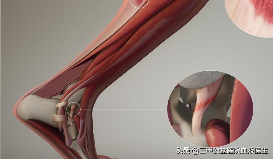 巴西队内马尔脚踝,内马尔脚踝90度扭曲