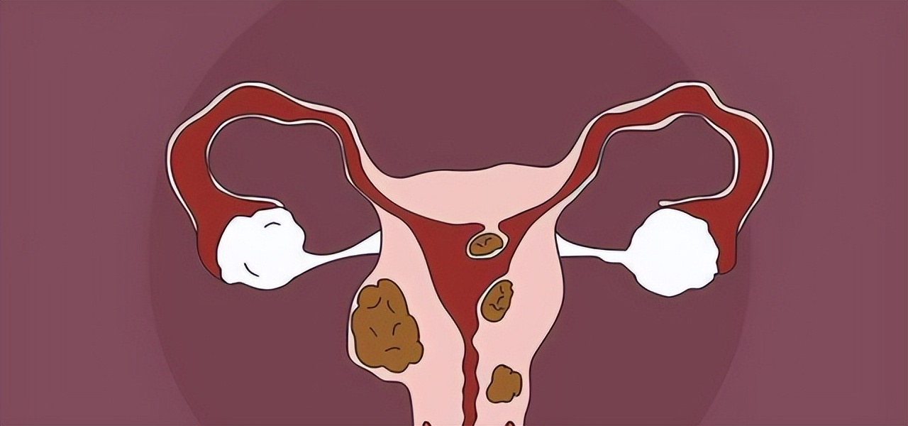 有子宫肌瘤芒果可以吃吗,有子宫肌瘤可以吃芒果吗