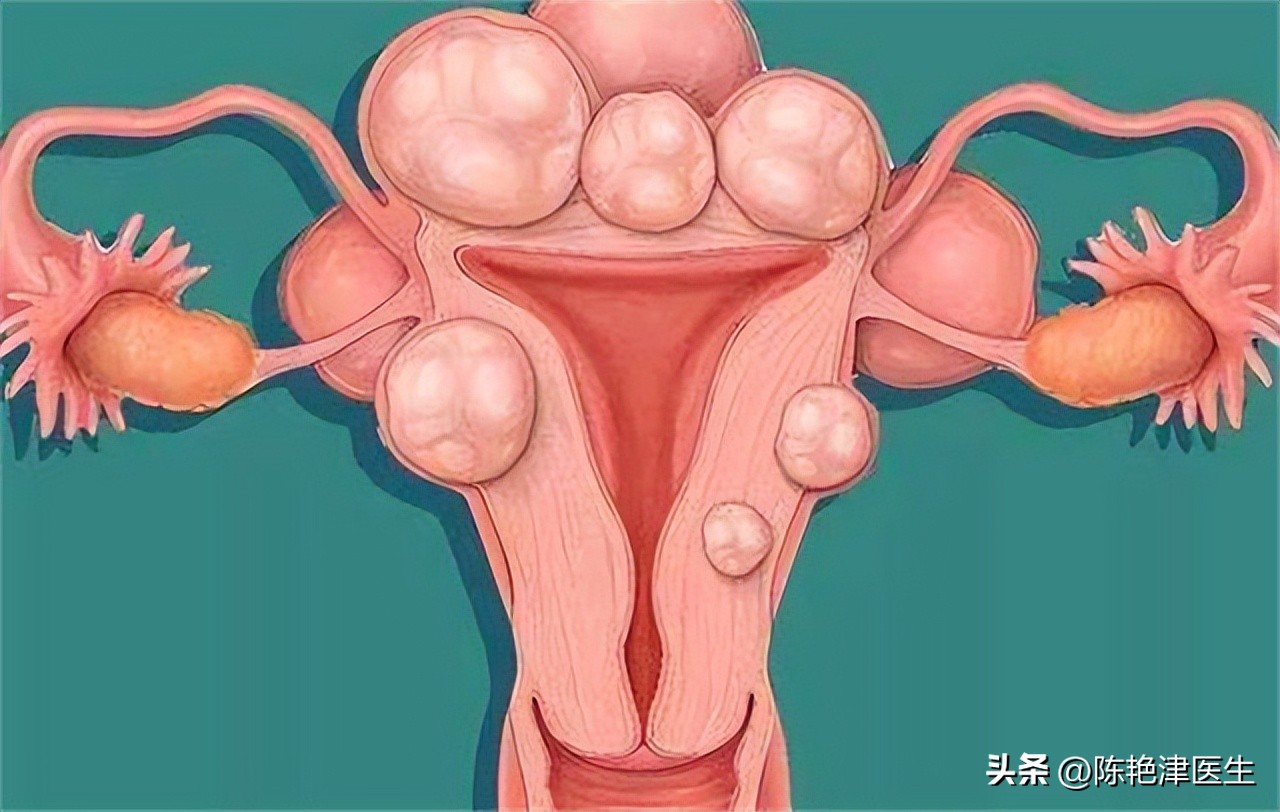 女性为什么容易长子宫肌瘤?提醒:平时尽量避免3个行为,别忽视