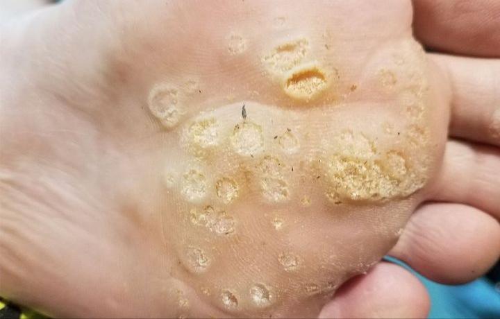 手足疣痊愈过程,跖疣治疗经验分享