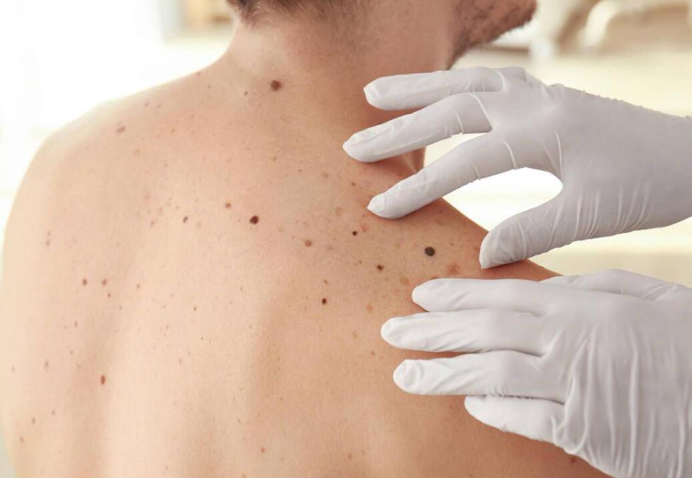 这8个部位长痣或是癌症前兆,痣长在身体这8个部位要小心癌症