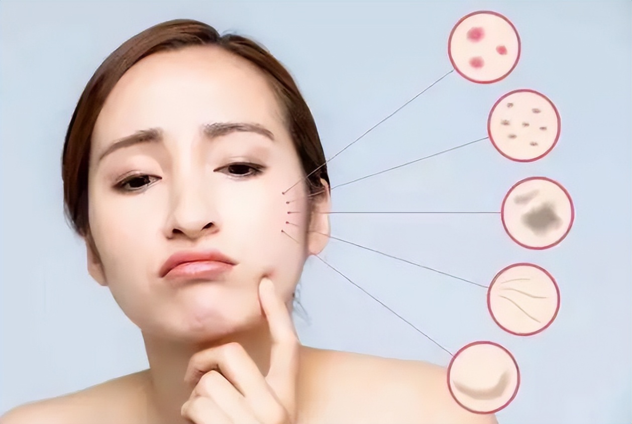 前胸后背痘痘怎么消除,前胸后背长了痘痘日常卫生要重视