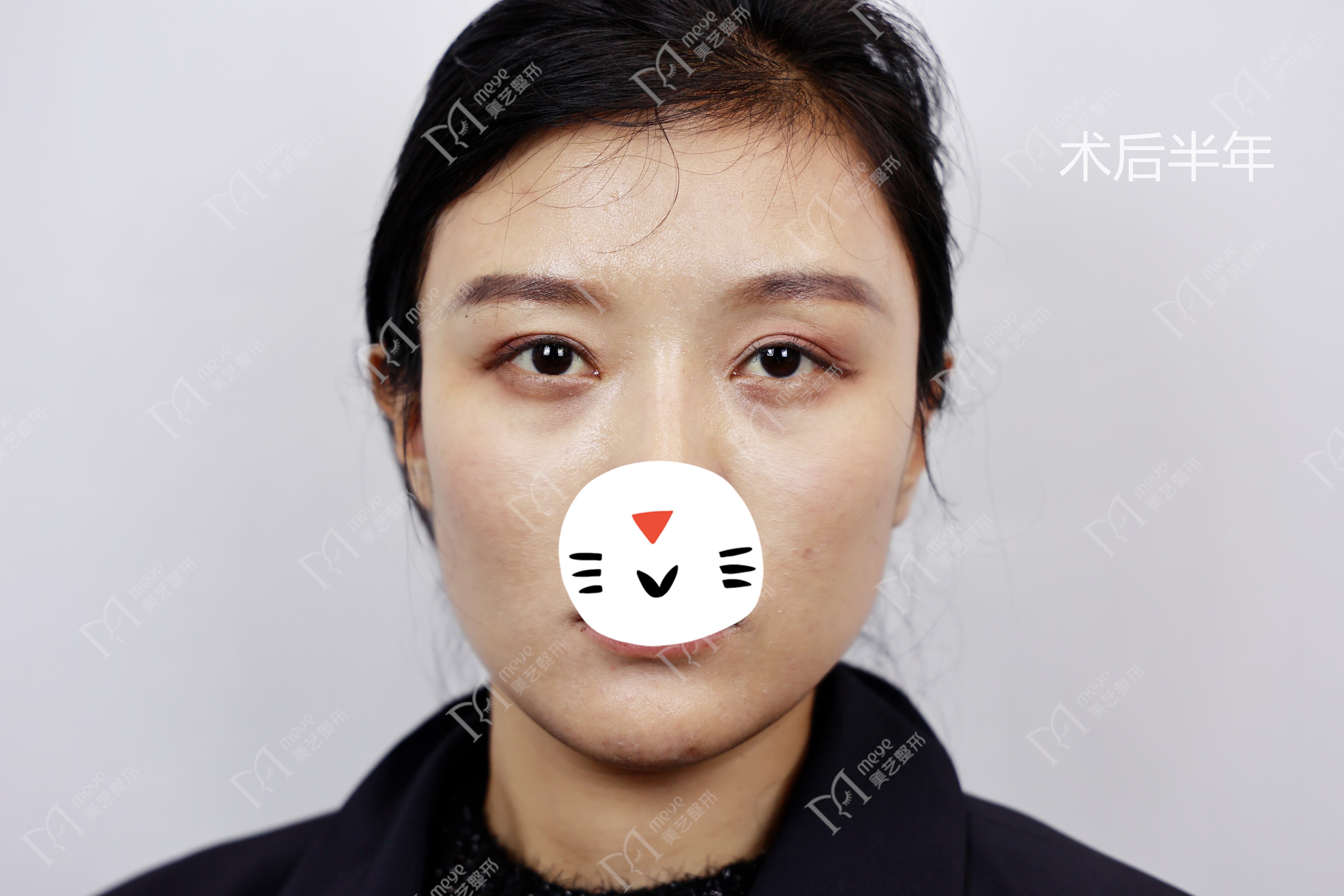 双眼皮修复新乡,姑娘眼部整形后双眼皮变三眼皮