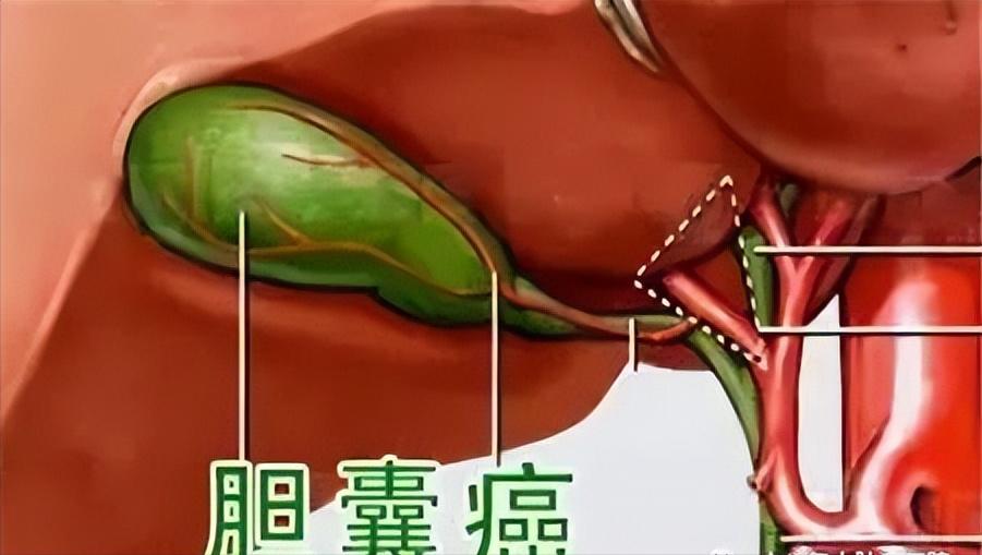 印度治胆囊癌,印度治疗癌症