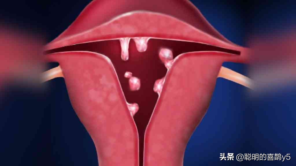 子宫里长息肉切除之后能怀孕吗,绝经后子宫息肉如果切除会复发吗