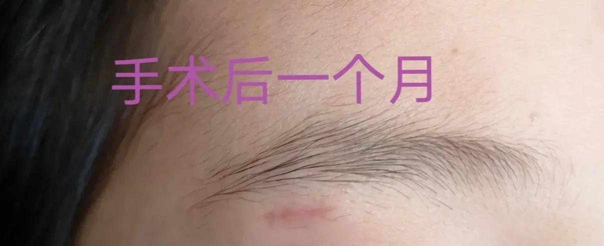 皮脂腺囊肿挤出囊袋,皮脂腺囊肿切除手术